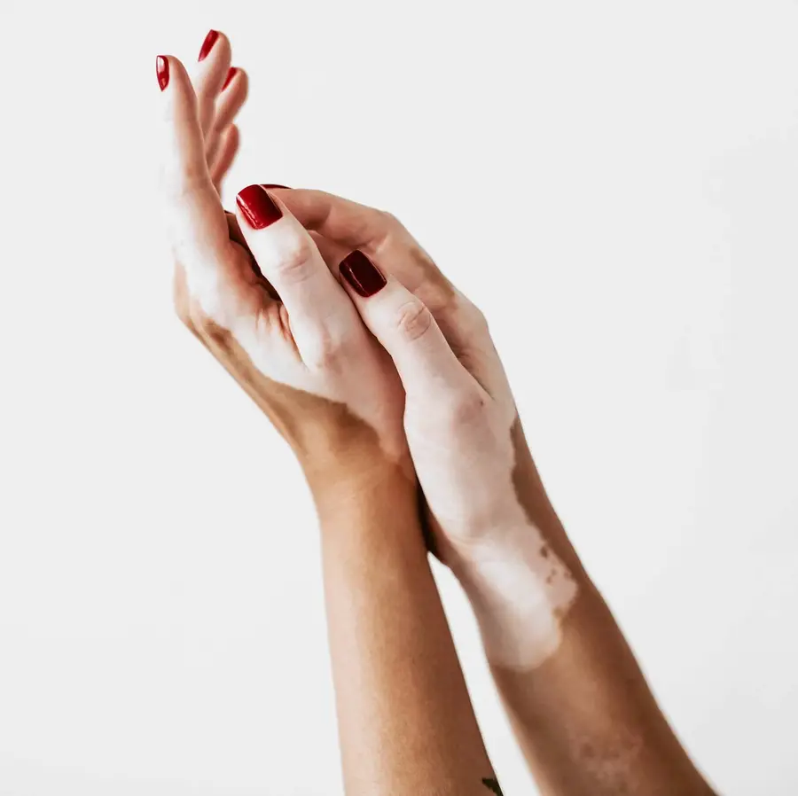 Imagem clínica educativa relacionada ao acompanhamento do vitiligo